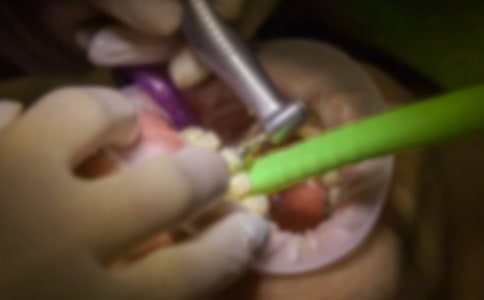 【热门】拔牙的作文300字3篇